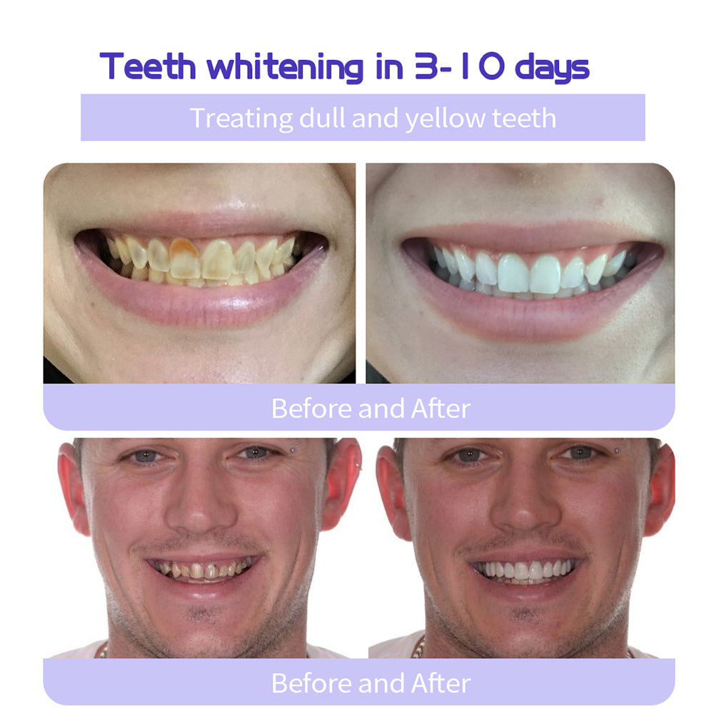 ODALIT™ Teeth Restoration Mineral Powder🦷(🎁Flash Sale - Don’t Miss Out)
