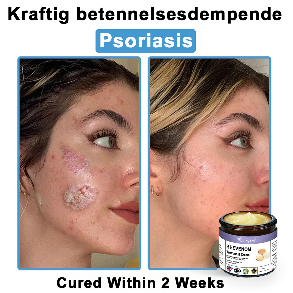 Ourlyard® Bee Venom Skin Treatment Cream👨‍⚕️Treats warts, growths, infections, and scars, smooths uneven skin, and is certified by the British Association of Dermatologists (BAD)