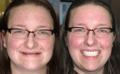 Custom-Fit Functional Dentures