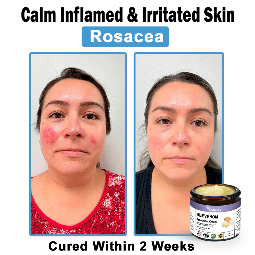 Ourlyard® Bee Venom Skin Treatment Cream👨‍⚕️Treats warts, growths, infections, and scars, smooths uneven skin, and is certified by the British Association of Dermatologists (BAD)