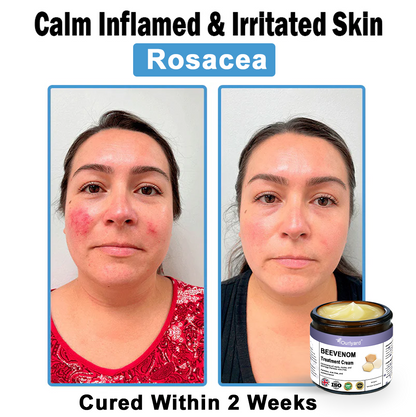 Ourlyard® Bee Venom Skin Treatment Cream👨‍⚕️Treats warts, growths, infections, and scars, smooths uneven skin, and is certified by the British Association of Dermatologists (BAD)
