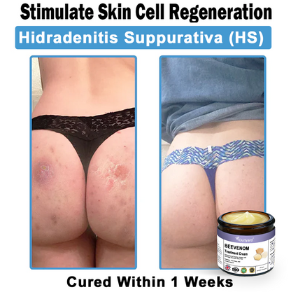 Ourlyard® Bee Venom Skin Treatment Cream👨‍⚕️Treats warts, growths, infections, and scars, smooths uneven skin, and is certified by the British Association of Dermatologists (BAD)